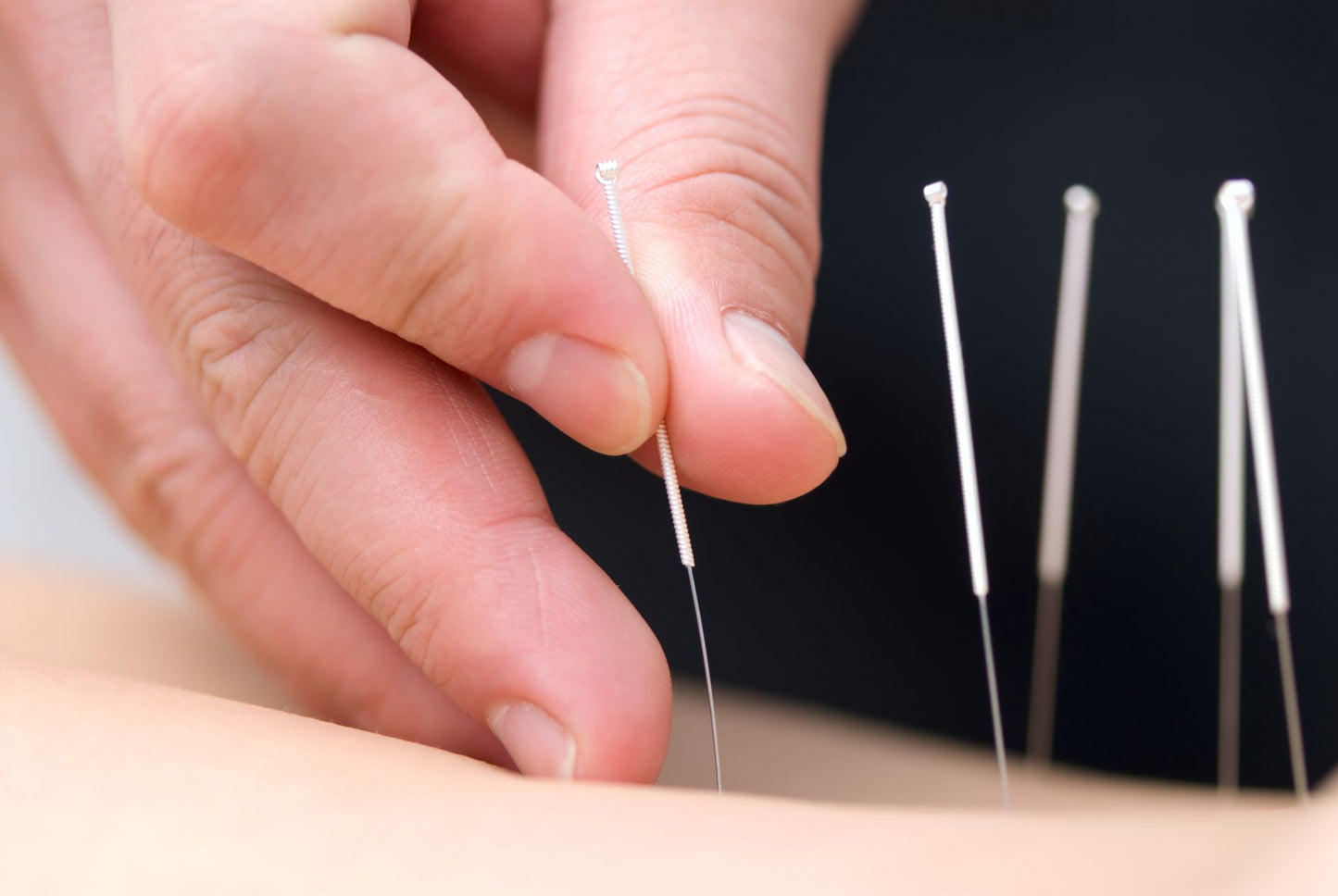 AcuPro needle - 0.30 x 50 mm - Dry Needling - Acupuncture